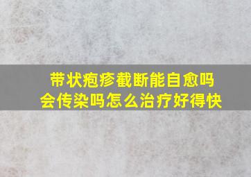 带状疱疹截断能自愈吗会传染吗怎么治疗好得快