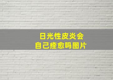 日光性皮炎会自己痊愈吗图片